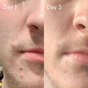 Sulfur Spot Treatment